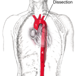aortic-dissection-diagram