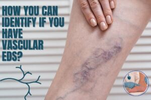 How You Can Identify If You Have Vascular EDS