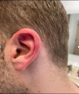 A close-up of a man's very red and swollen ear.