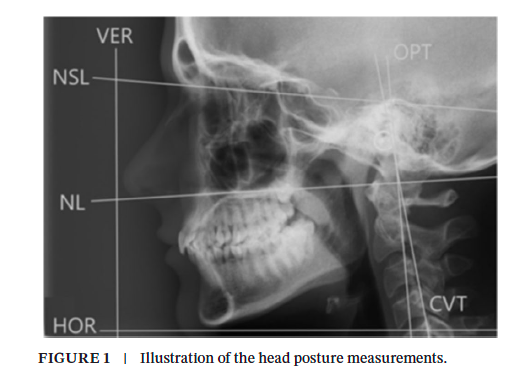 A radiographic image of the left side of a human skull with lines running from various features creating angles that are labeled.