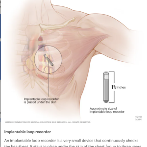 An anatomical drawing of a human's left upper chest and shoulder. A highlighted area shows a small silver rod sitting above the lower left side of the heart. Text referring to it says, "Implantable loop recorder is placed under the skin." An inset shows the implantable loop recorder and that it measures 1 and 3/4 inches long. The label of the inset reads, "Approximate size of implantable loop recorder." The caption of the image reads Title "Implantable Loop Recorder" end title. Caption text: "An implantable loop recorder is a very small device that continuously checks the heartbeat. It stays in place under the skin of the chest for up to three years."
