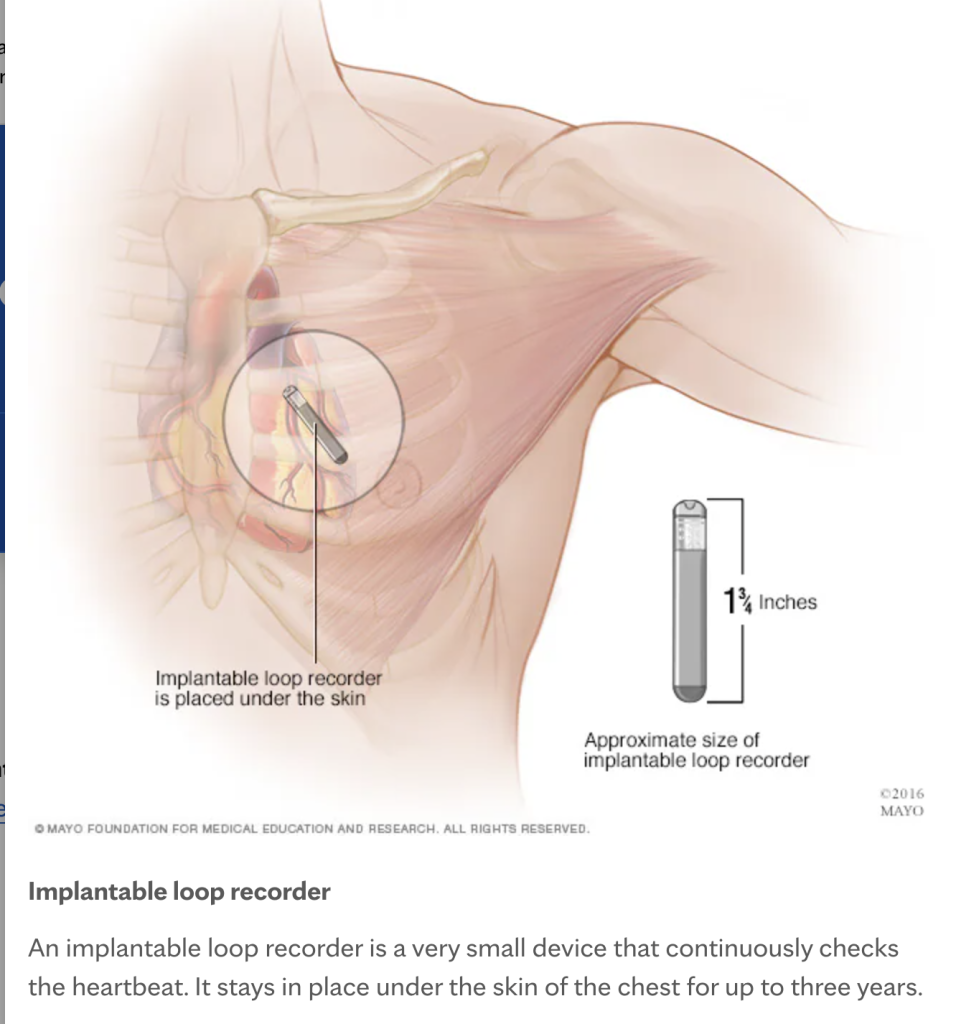 An anatomical drawing of a human's left upper chest and shoulder. A highlighted area shows a small silver rod sitting above the lower left side of the heart. Text referring to it says, "Implantable loop recorder is placed under the skin." An inset shows the implantable loop recorder and that it measures 1 and 3/4 inches long. The label of the inset reads, "Approximate size of implantable loop recorder." The caption of the image reads Title "Implantable Loop Recorder" end title. Caption text: "An implantable loop recorder is a very small device that continuously checks the heartbeat. It stays in place under the skin of the chest for up to three years."