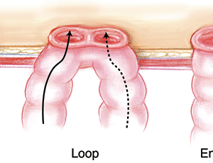 Medical illustration comparing three common stoma configurations. From left to right: an end stoma, a loop stoma, and an end-loop stoma. The end stoma shows a single opening brought through the abdominal wall. The loop stoma shows a loop of bowel partially brought to the surface, creating two openings. The end-loop stoma combines features of both, with a primary functioning stoma and a smaller secondary opening. Black arrows indicate the direction of intestinal flow through each stoma type. Labels beneath each illustration read “End,” “Loop,” and “End-Loop.”