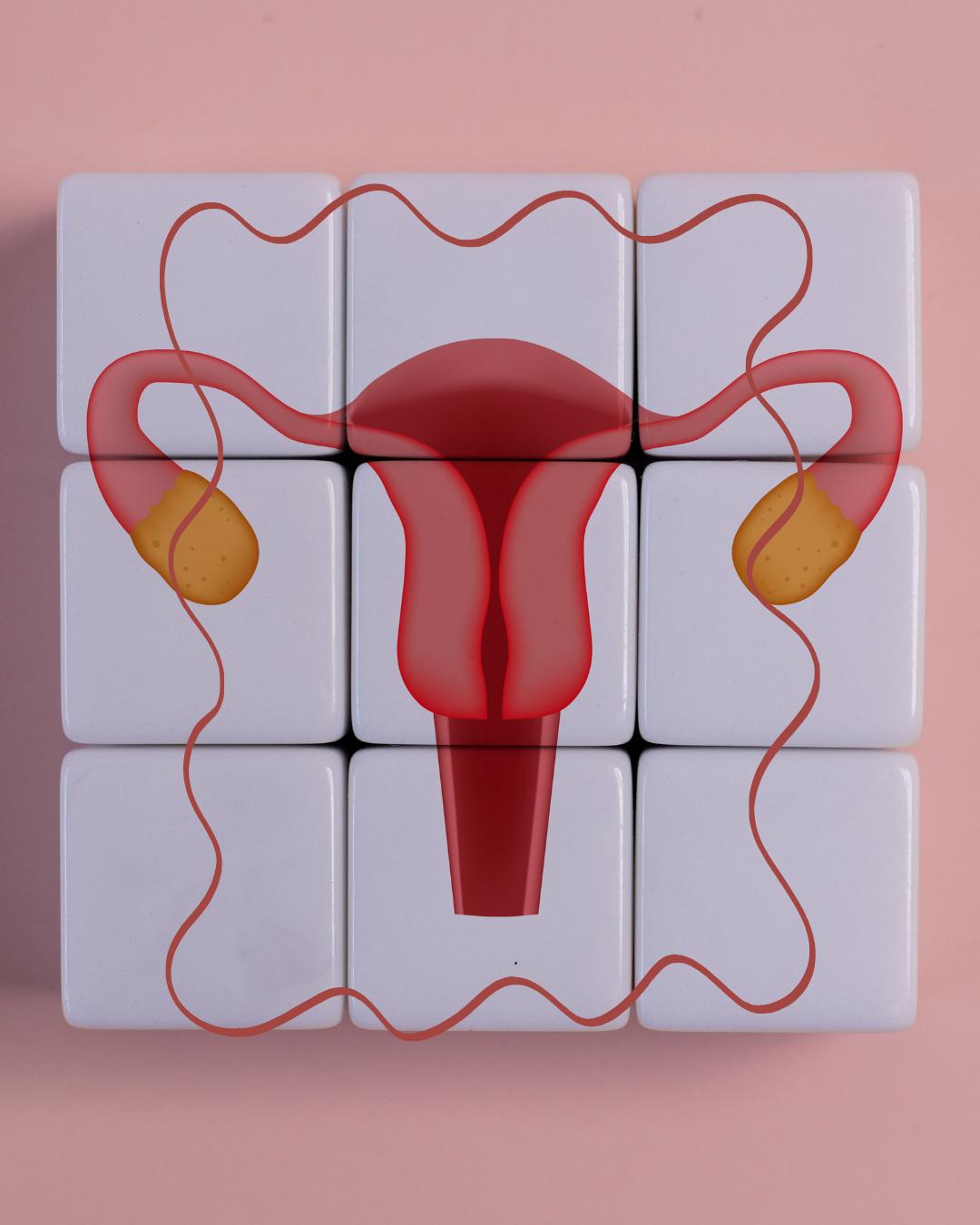 A Name Long Overdue: PCOS Becomes PMOS, and What That Means for the hEDS Community