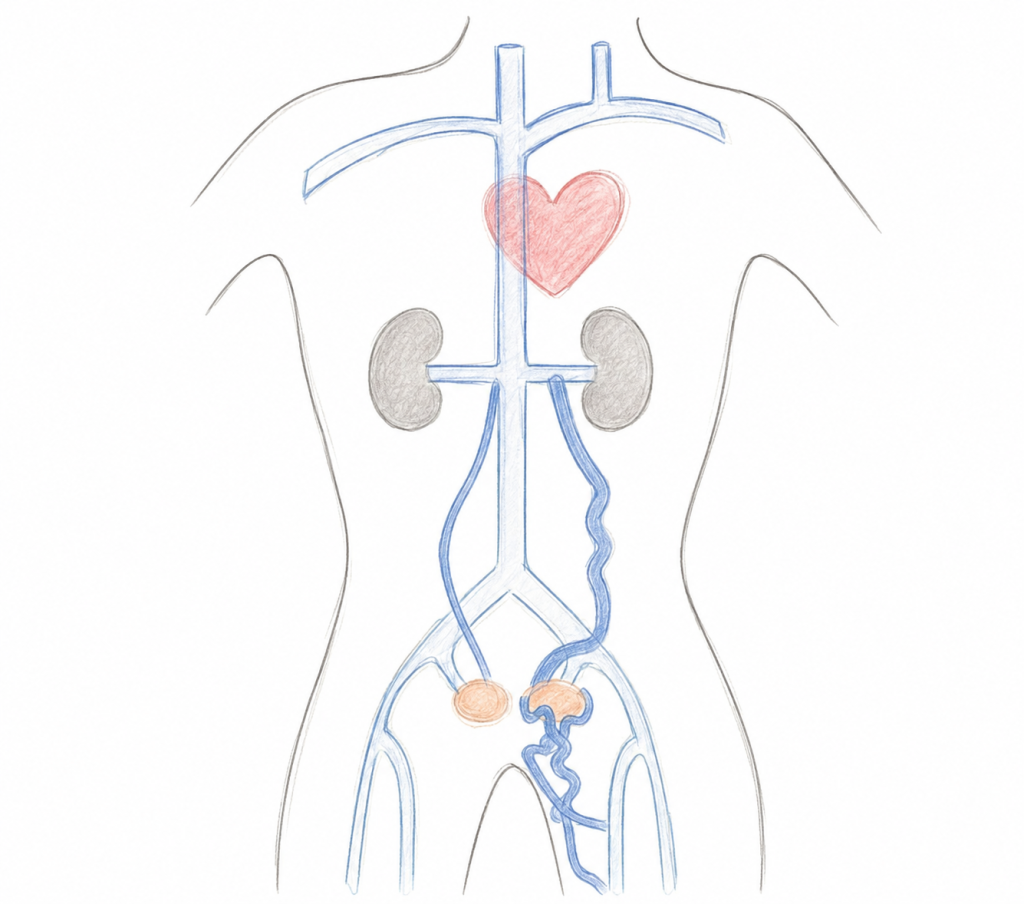 Simple anatomical illustration of the torso showing pelvic congestion syndrome. The heart, kidneys, and major veins are outlined, with enlarged, twisted blue veins extending from the left pelvic vein around the left ovary and into the pelvis, illustrating pelvic venous reflux and varicose pelvic veins. The drawing uses soft, hand-sketched lines with a clean white background.